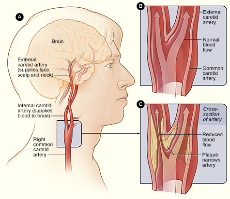 Carotid Arteries