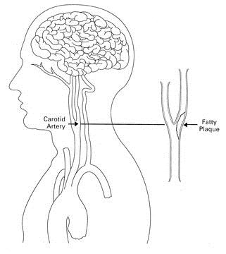 Carotid_Artery_Plaque