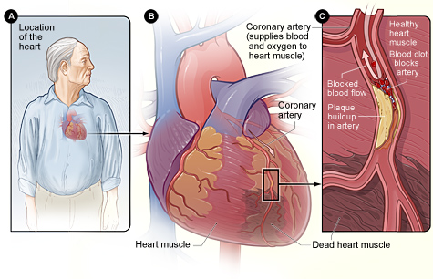 Figure A shows the location of the heart in the body. Figure B is an overview of a heart and coronary artery showing damage (dead heart muscle) caused by a heart attack. Figure C is a cross-section of the coronary artery with plaque buildup and a blood clot