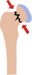 Hip Fracture