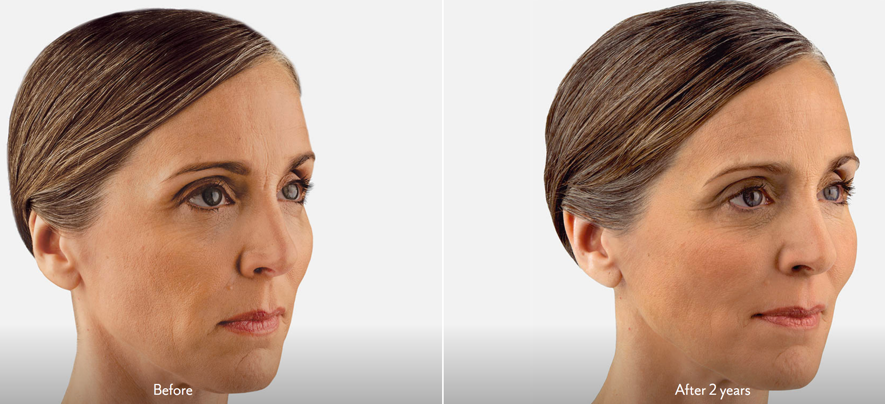 “Juvederm