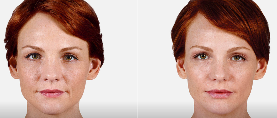 Juvederm Treatment Photo