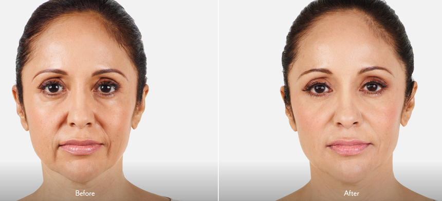 Juvederm Treatment