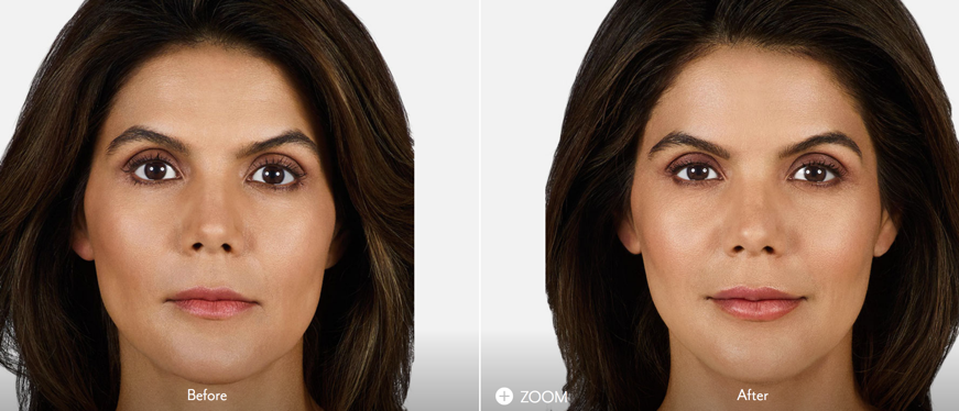 Juvederm