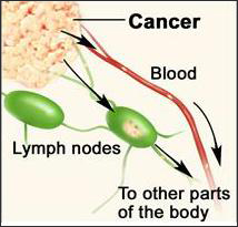 metastatic cancer