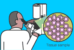 cancer screening biopsy