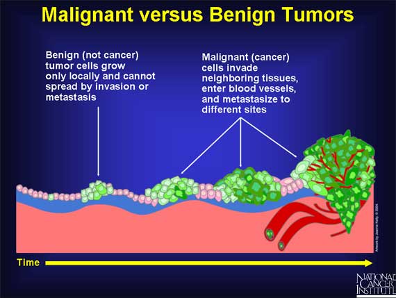 stages of cancer growth