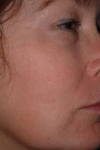Chemical peels - before treatment
