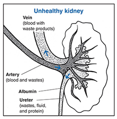 diabetes_nephropathy_kidney.jpg