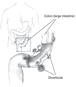 Diverticulitis Diverticulosis
