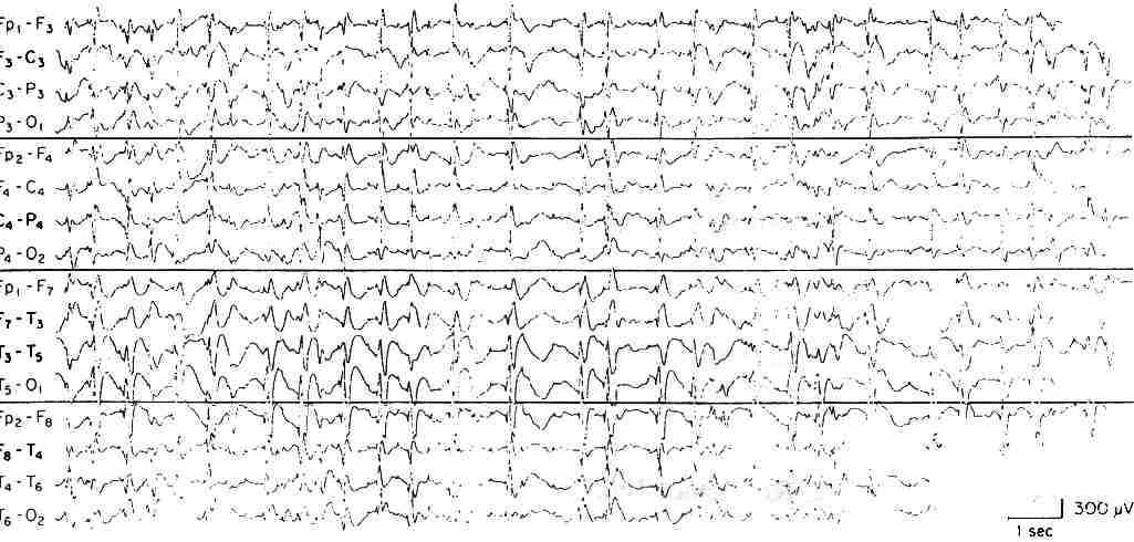 Electronencephalogram (EEG)