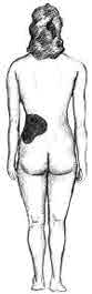 Kidney stone back