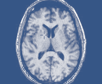 MRI