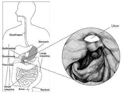 Peptic Ulcer