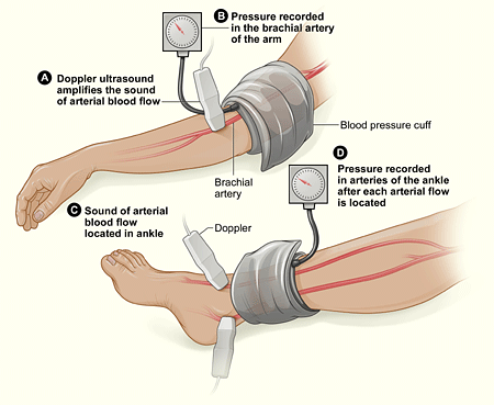 Ankle-brachial index (ABI) test for peripheral artery disease
