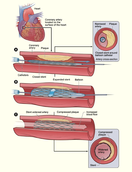 Coronary artery stent placement