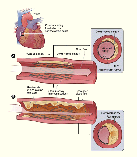 Restenosis after stent placement