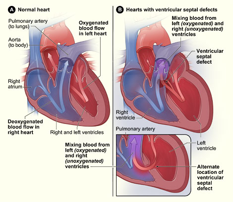 Ventricular Septal Defect Anatomy