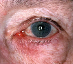 rosacea eyes