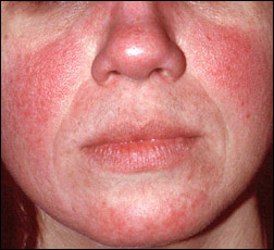 rosacea redness