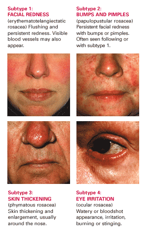 National Rosacea Foundation