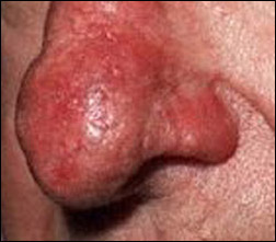 rosacea skin thickening
