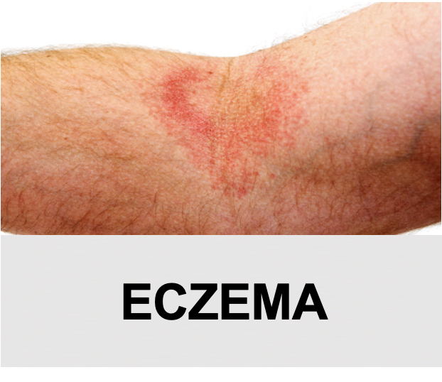 Eczema - What Is It?