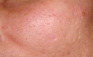 Acne Scars