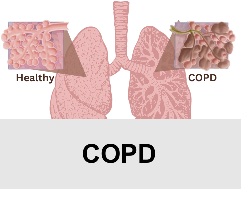 COPD (Chronic Bronchitis, Emphysema)