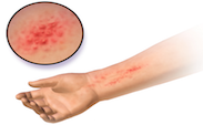 Contact Dermatitis