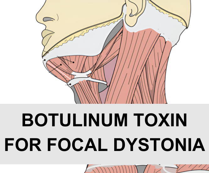 Botulinum Toxin for Focal Dystonia