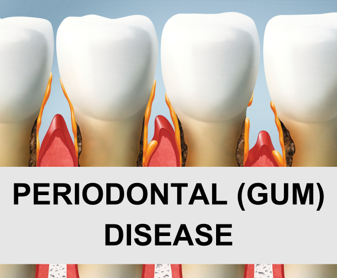 Periodontal (Gum) Disease
