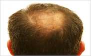 Hair Loss