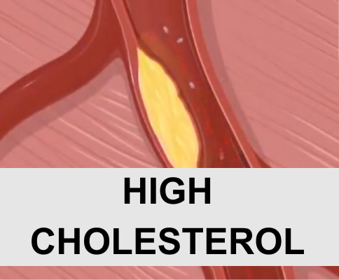 High Cholesterol (Hypercholesterolemia)