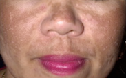 Melasma
