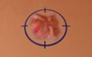 Mohs Surgery