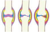 Osteoarthritis