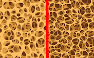 Osteoporosis