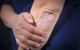 Psoriasis