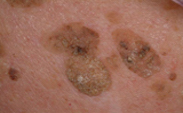 Seborrheic Keratoses