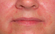Seborrheic Dermatitis