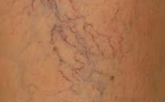 Spider Veins