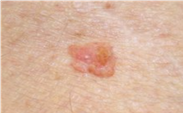 Squamous Cell Carcinoma