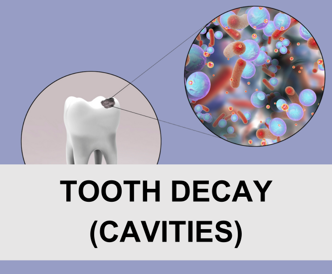 Tooth Decay (Cavities)