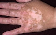 Vitiligo