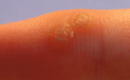 Warts