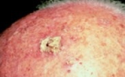 Actinic Keratoses