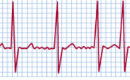 Atrial Fibrillation