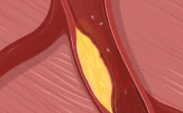Coronary Artery Disease
