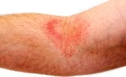 Eczema